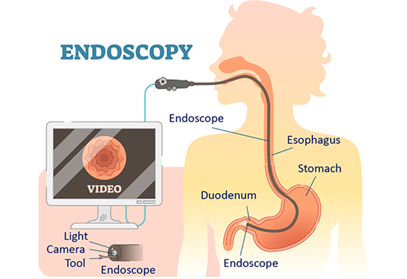 ENDOSCOPY