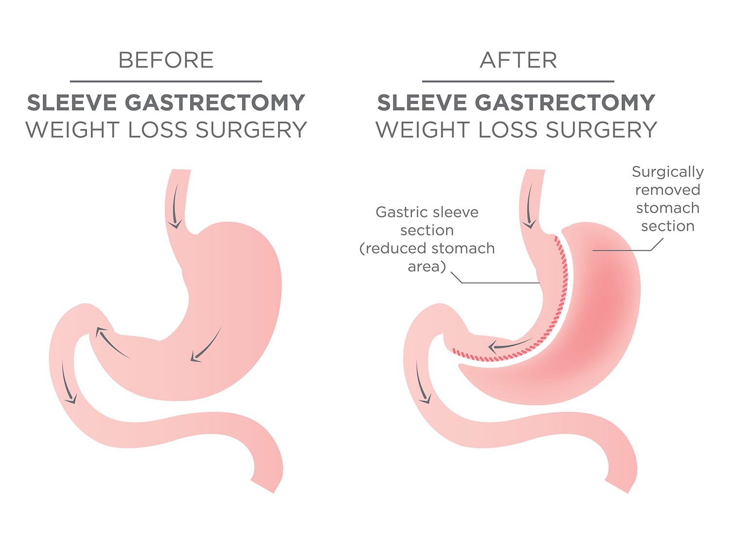 Laparoscopic Bariatric Surgery and Hiatus hernia repair