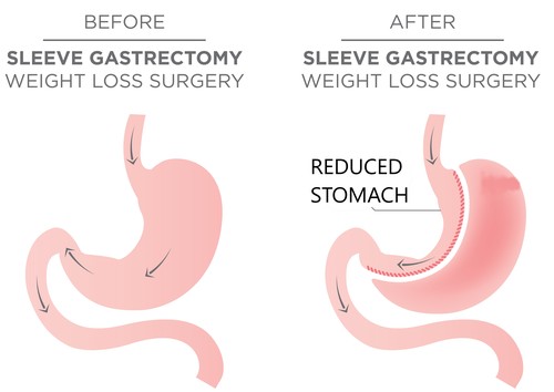 Weight Loss Surgery